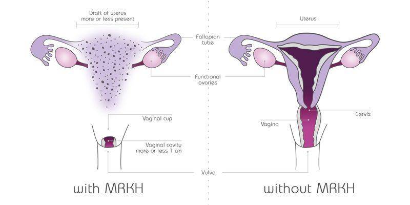 Sindrom Mayer-Rokitansky-Küster-Hauser (antaihospitals.com)