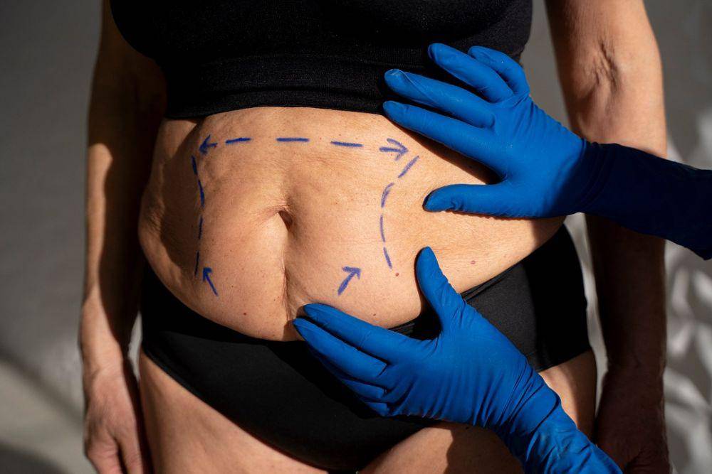 ilustrasi prosedur tummy tuck (freepik.com/Freepik)