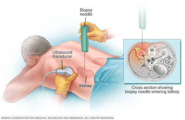 ilustrasi biopsi ginjal (beaconhealthsystem.org/Mayo Clinic)