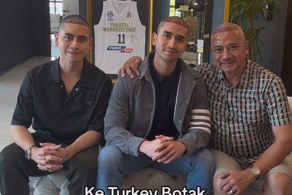 Verrell Bramasta Jalani Transplantasi Rambut Bareng Adik dan Ayah