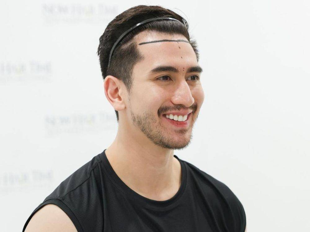 Verrell Bramasta sebelum melakukan transplantasi rambut. (Instagram @bramastavrl)