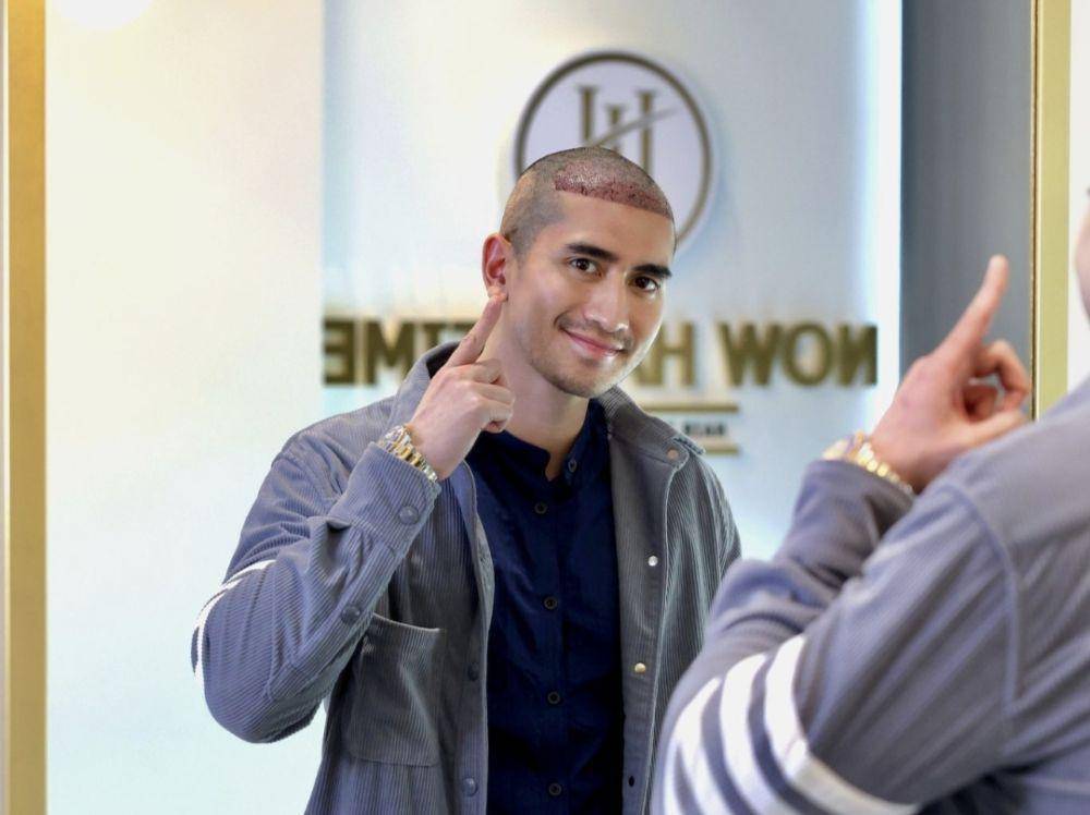 Verrell Bramasta setelah melakukan transplantasi rambut. (Instagram @bramastavrl)