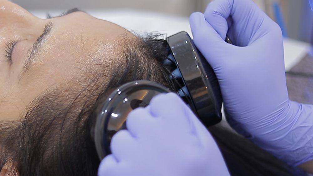 5 Rekomendasi Klinik Kecantikan untuk Perawatan Mencegah Kerontokan