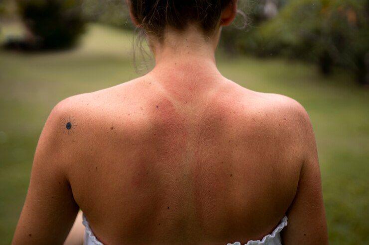 Bolehkah Mengaplikasikan Minyak Kelapa saat Sunburn? Perhatikan!