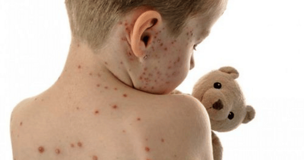 Kasus Suspek Campak Merebak, NTB Tetapkan KLB di Bima dan Dompu