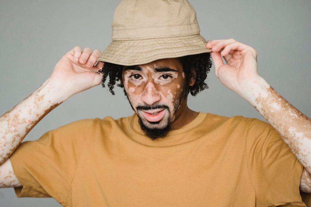 Fakta Vitiligo, Kelainan Penyebab Warna Kulit Memudar