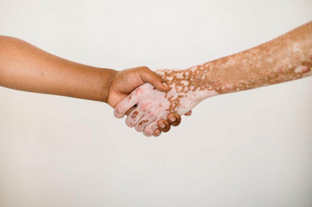 ilustrasi vitiligo di tangan (pexels.com/Armin Rimoldi)