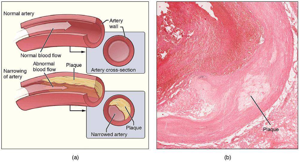 ilustrasi aterosklerosis (commons.wikimedia.org/Anatomy & Physiology, Connexions Web site. http://cnx.org/content/col11496/1.6/, Jun 19, 2013)