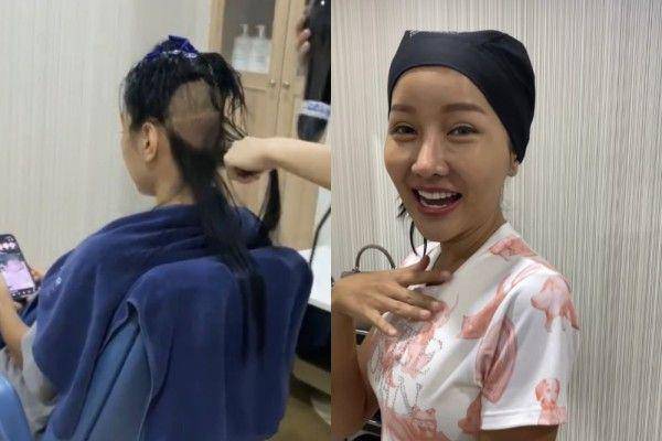 potret Lucinta Luna transplantasi rambut di Bangkok (Instagram.com/lucintaluna_manjalita)