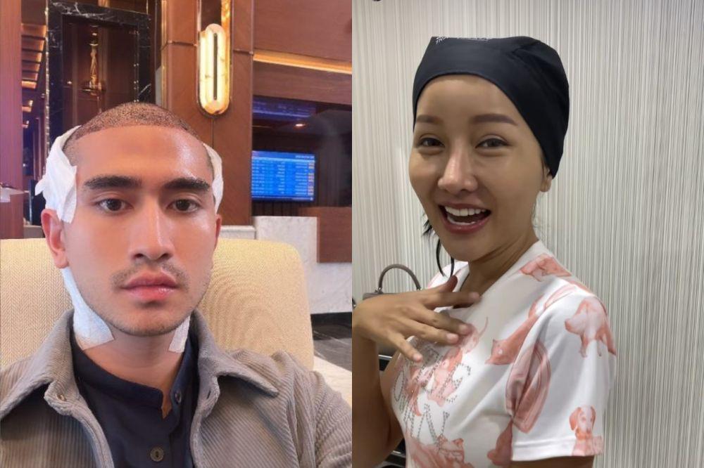 15 Artis yang Jalani Transplantasi Rambut, Terbaru Verrell Bramasta