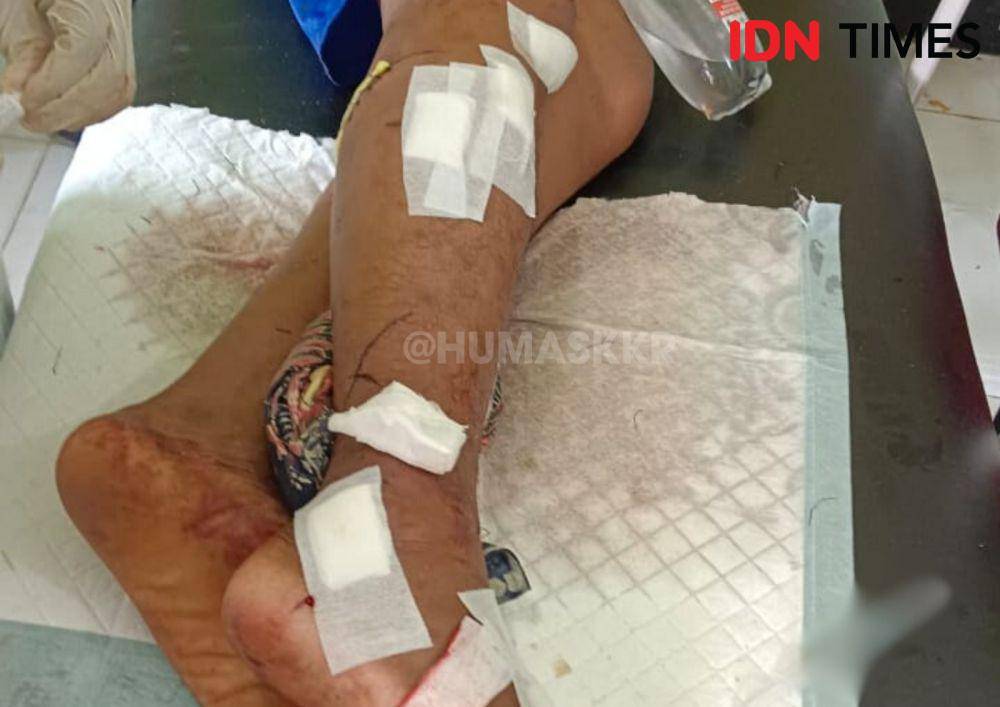 Kaki korban diterkam buaya alami patah tulang dan luka. (IDN Times/Polres Kubu Raya).