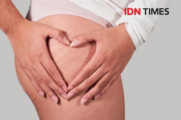 7 Alasan Munculnya Stretch Mark di Paha, Kamu Harus Tahu!