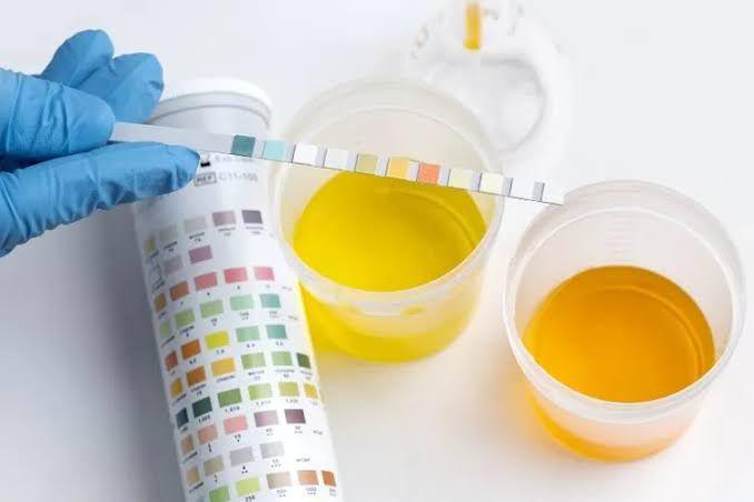 7 Warna Urine Jadi Penanda Baik Buruknya Kesehatan