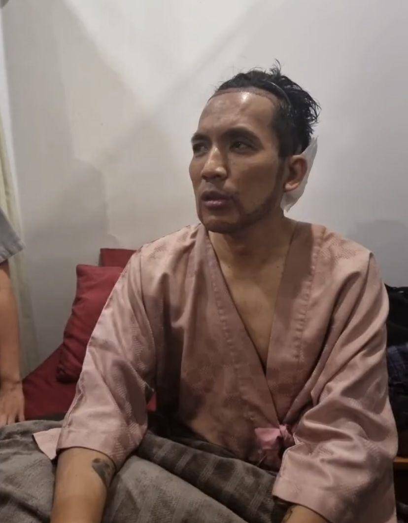 potret Desta transplantasi rambut di klinik dr. Tompi (Instagram.com/beyoutifulhairtransplantcenter)