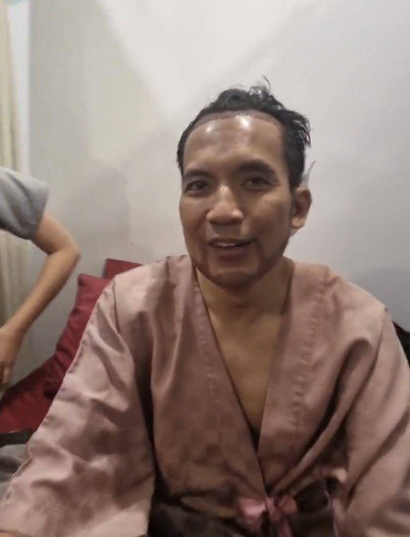 potret Desta transplantasi rambut di klinik dr. Tompi (Instagram.com/beyoutifulhairtransplantcenter)