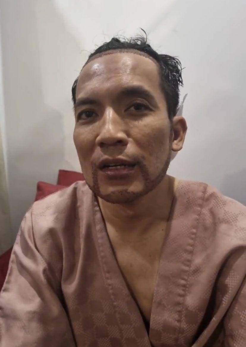 potret Desta transplantasi rambut di klinik dr. Tompi (Instagram.com/beyoutifulhairtransplantcenter)