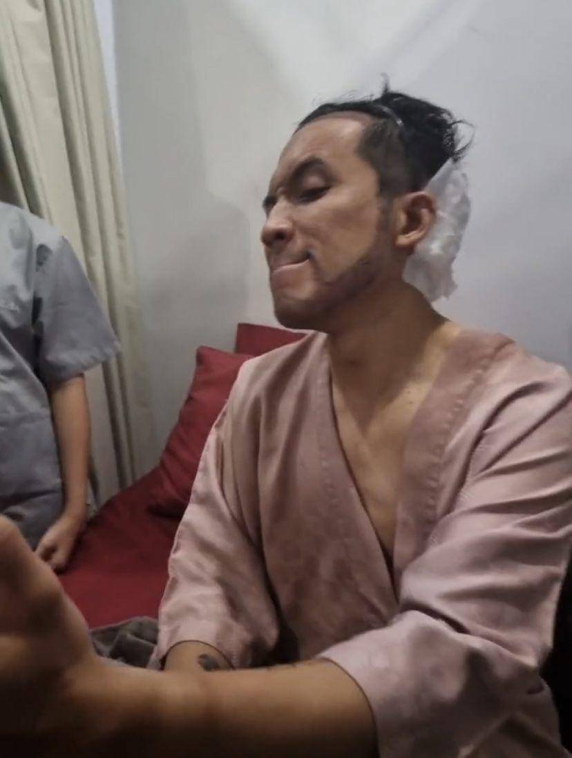 potret Desta transplantasi rambut di klinik dr. Tompi (Instagram.com/beyoutifulhairtransplantcenter)