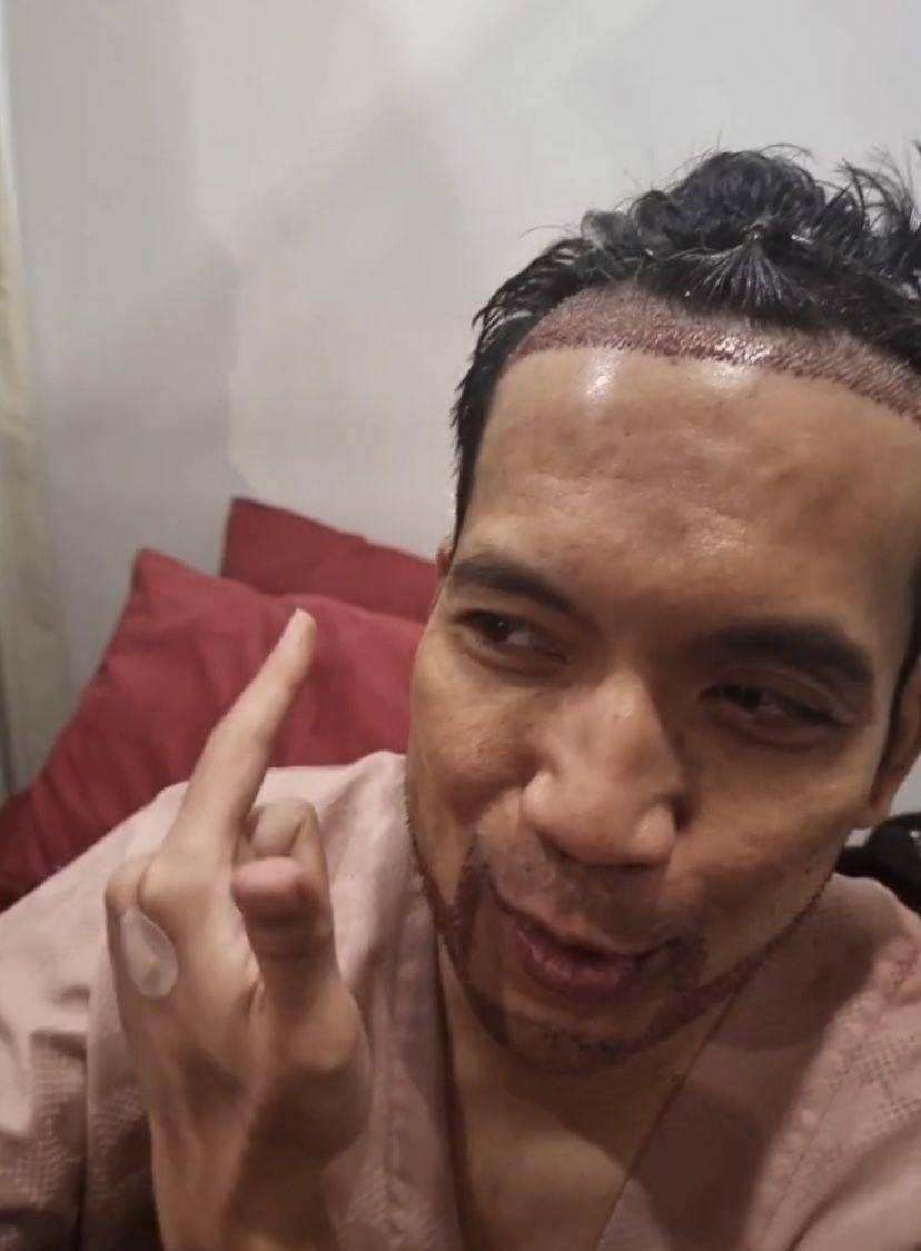potret Desta transplantasi rambut di klinik dr. Tompi (Instagram.com/beyoutifulhairtransplantcenter)