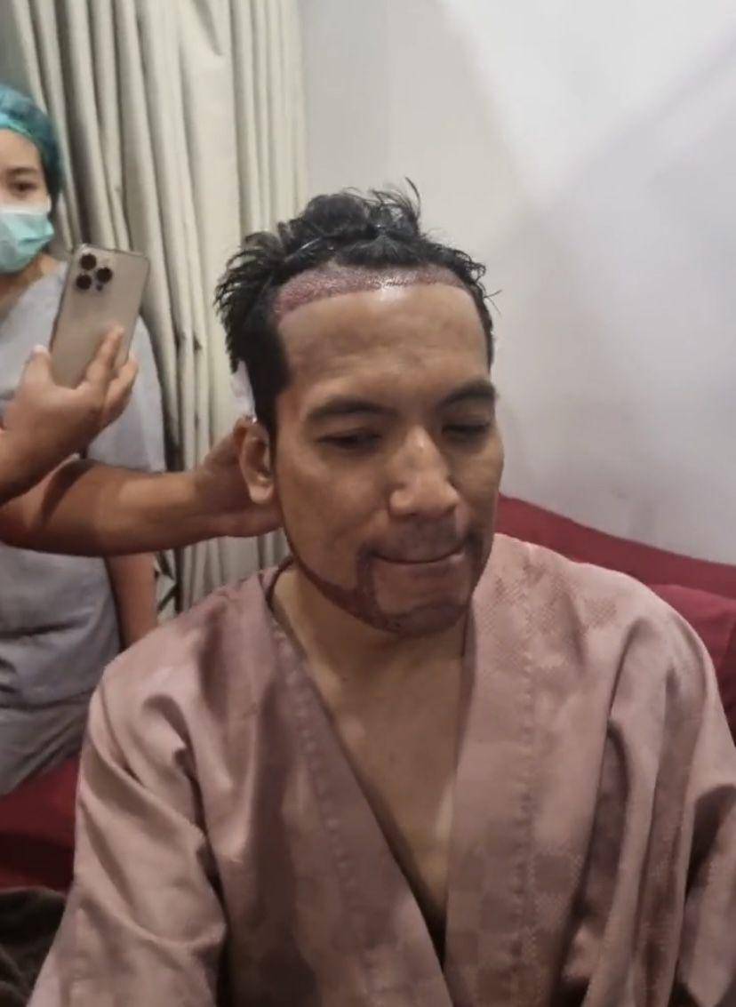 potret Desta transplantasi rambut di klinik dr. Tompi (Instagram.com/beyoutifulhairtransplantcenter)