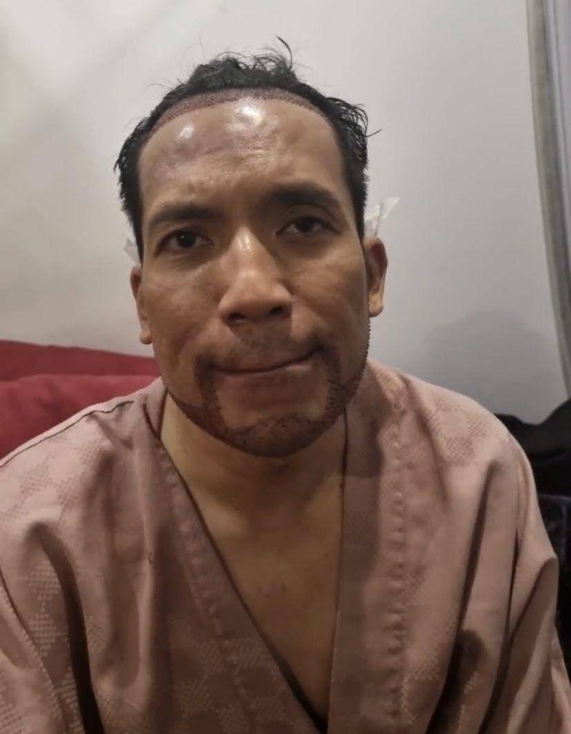 potret Desta transplantasi rambut di klinik dr. Tompi (Instagram.com/beyoutifulhairtransplantcenter)