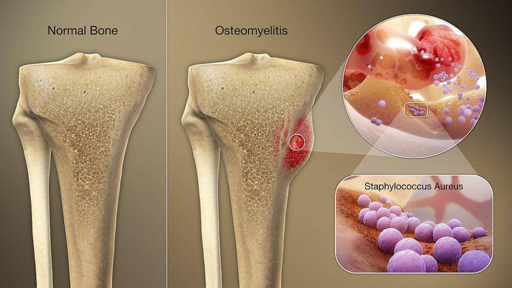 ilustrasi osteomielitis (common.wikimedia.org/scientificanimation.com)