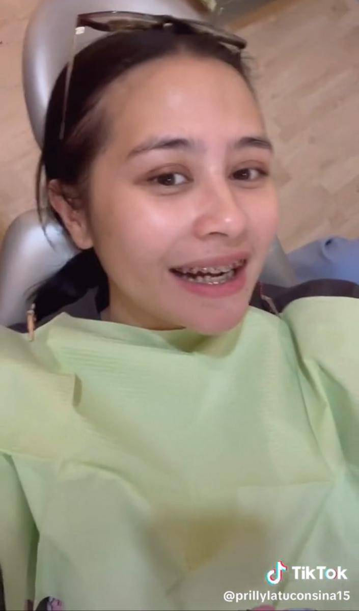 Penampilan baru Prilly pakai behel (Tiktok.com/prillylatuconsina15)