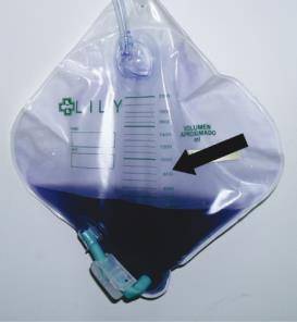 sindrom kantung urine ungu (craighospital.org)