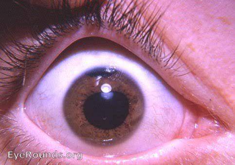 iris mata yang terkelupas (webeye.ophth.uiowa.edu)