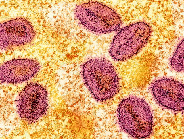 Afrika Umumkan Darurat Kesehatan akibat Wabah Mpox