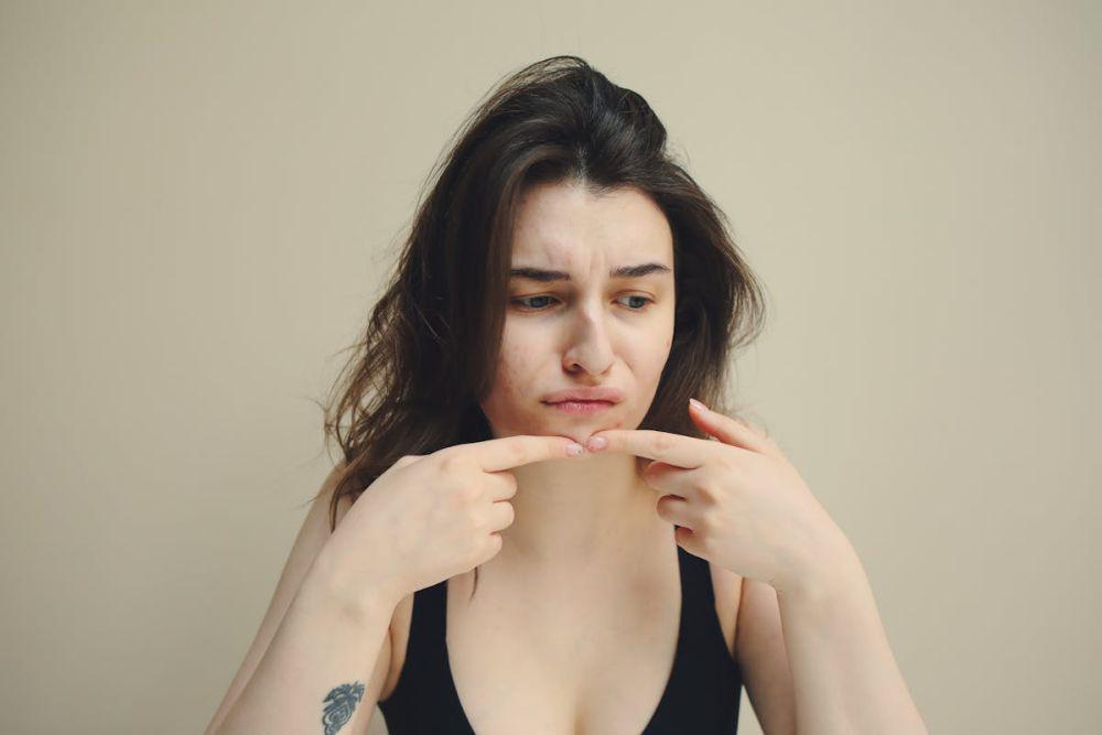 ilustrasi kulit berjerawat (pexels.com/Polina Tankilevitch)