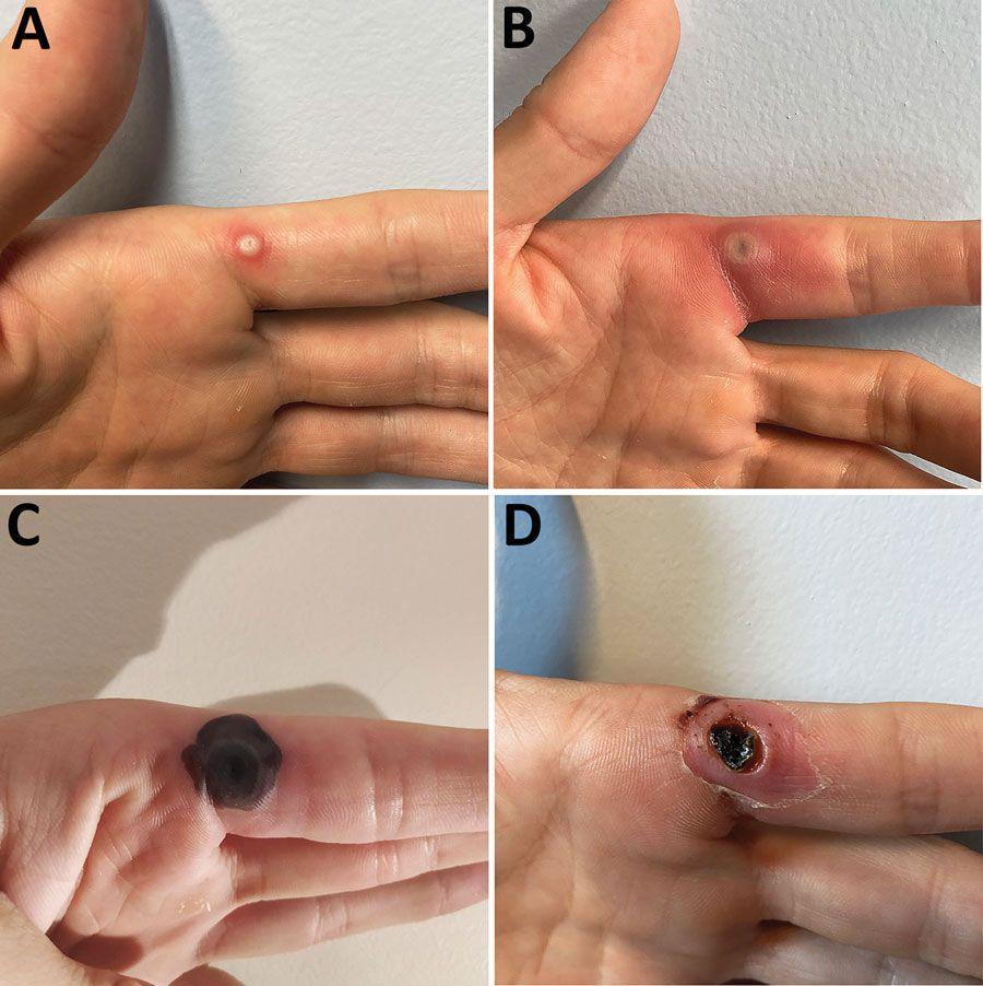 ilustrasi lesi mpox (commons.wikimedia.org/https://wwwnc.cdc.gov/eid/article/28/12/22-1374-f1/João P. Caldas, Sofia R. Valdoleiros, Sandra Rebelo, and Margarida Tavares)