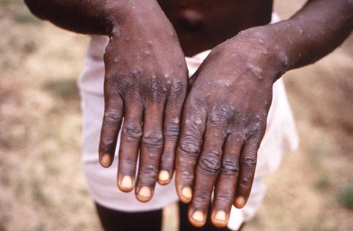 Kasus Cacar Monyet di Afrika Meningkat Lebih Dari 500 Persen