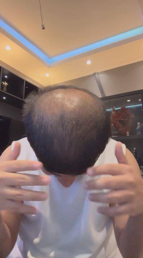 potret Fadil Jaidi tanam rambut (instagram.com/fadiljaidi)