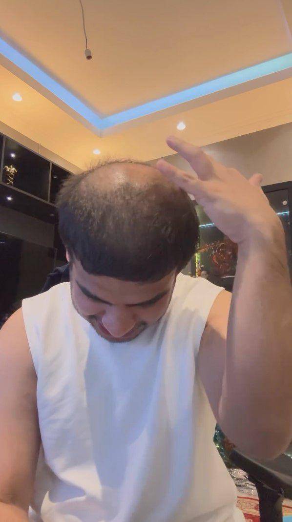 potret Fadil Jaidi tanam rambut (instagram.com/fadiljaidi)