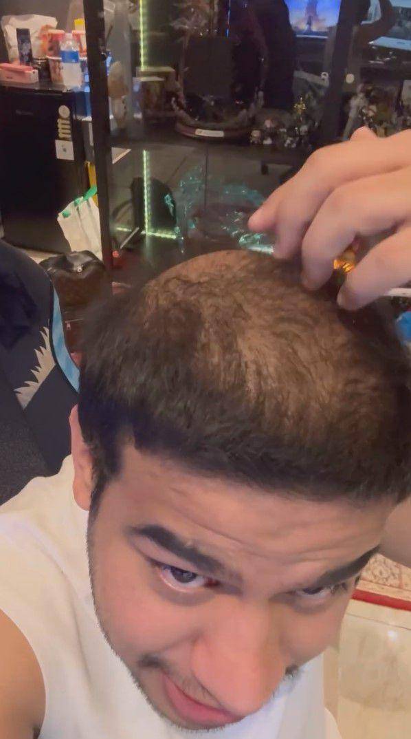 potret Fadil Jaidi tanam rambut (instagram.com/fadiljaidi)