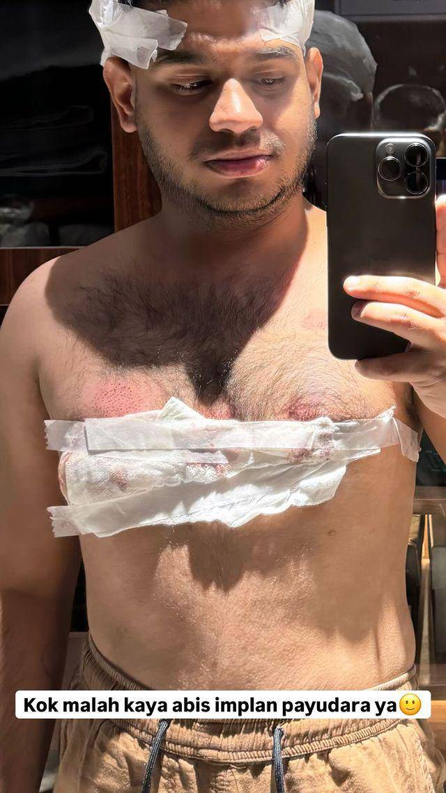 potret Fadil Jaidi tanam rambut (instagram.com/fadiljaidi)
