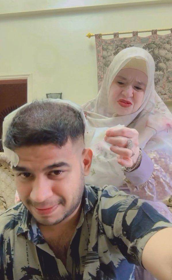 potret Fadil Jaidi tanam rambut (instagram.com/fadiljaidi)