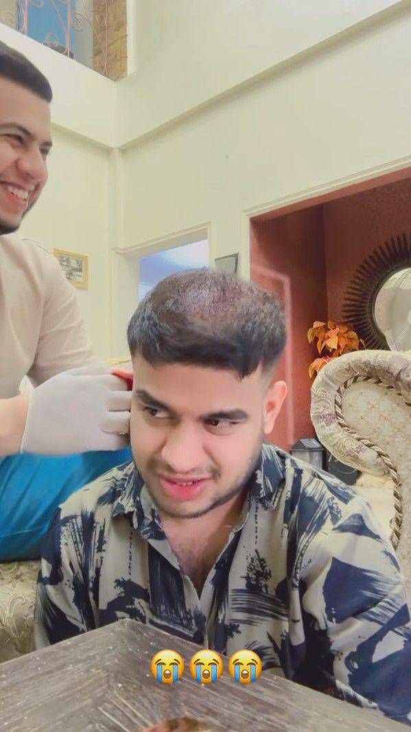 potret Fadil Jaidi tanam rambut (instagram.com/fadiljaidi)