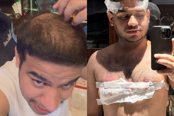 Alami Kebotakan, 8 Potret Fadil Jaidi Tanam Rambut