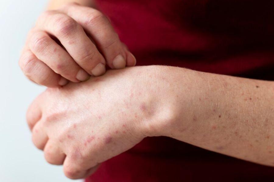 [QUIZ] Seberapa Paham Kamu tentang Monkeypox? Uji Pengetahuanmu dengan Kuis Ini!