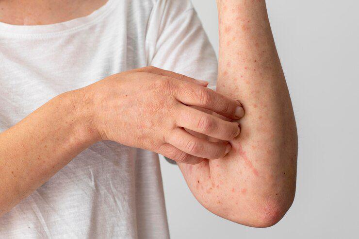 Menkes Yordania Umumkan Kasus Mpox Pertama