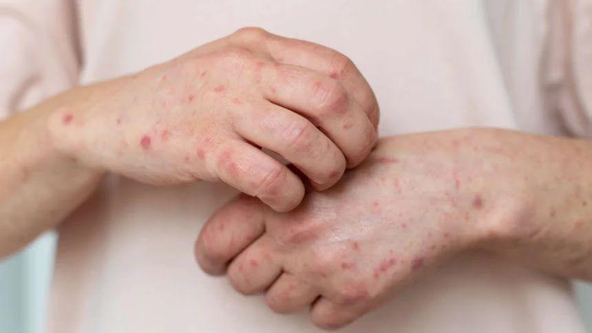 Bantah Ada Mpox di Situbondo, Dinkes Jatim Ajak Kenali Gejalanya