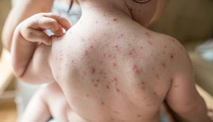 Suspek Mpox Pertama Diumumkan di Palembang