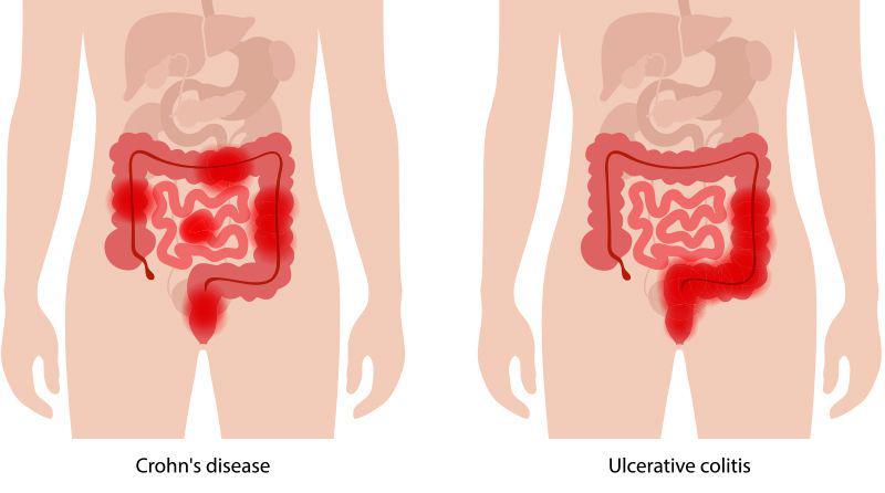 Ilustrasi penyakit Crohn (trs.texas.gov)