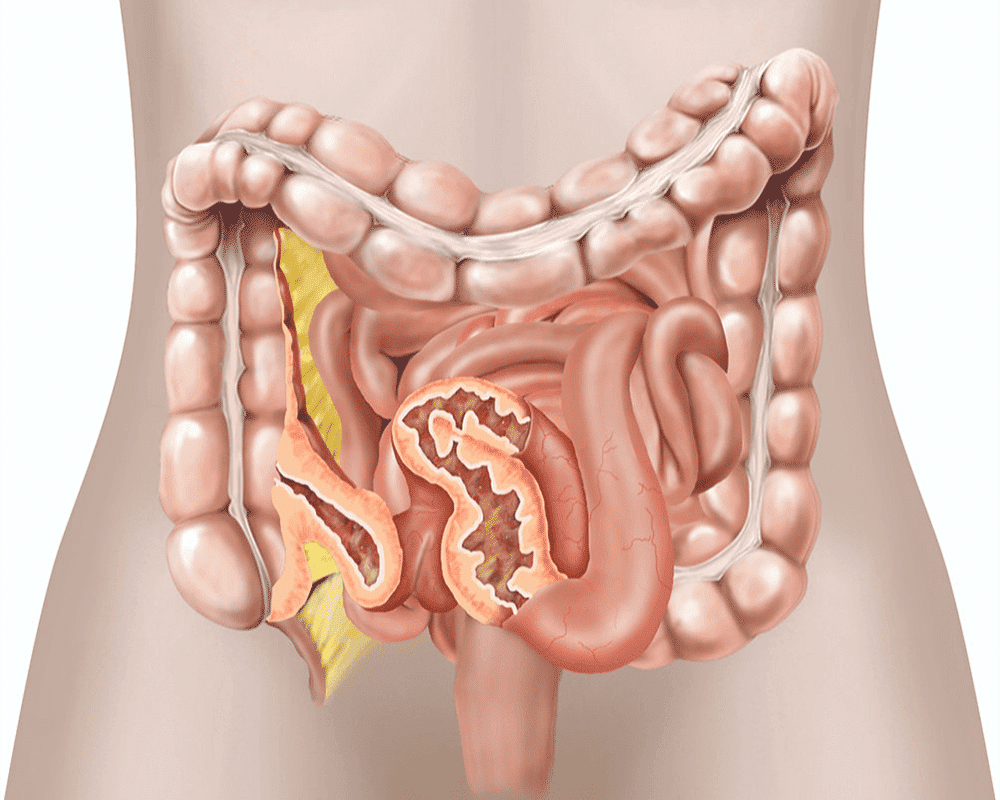 Ilustrasi penyakit Crohn (healthdirect.gov)