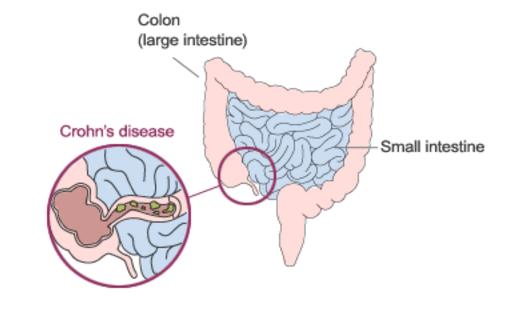 Ilustrasi penyakit Crohn (bonheurmd.com)