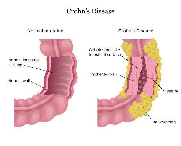 Ilustrasi penyakit Crohn (samarpanphysioclinic.com)