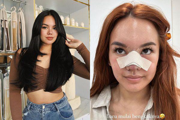 7 Potret Shafa Harris Operasi Plastik di Korea Selatan