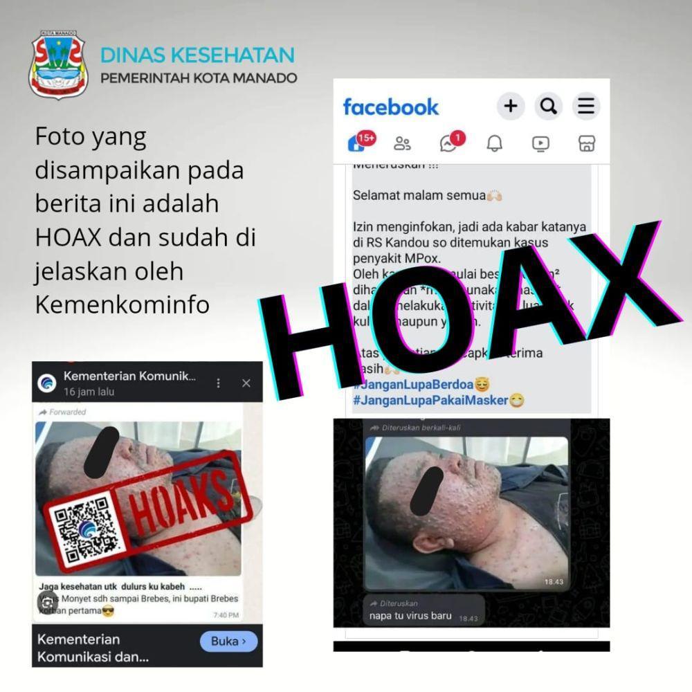 Dinkes Sulawesi Utara Bantah Penyakit Mpox Masuk Manado