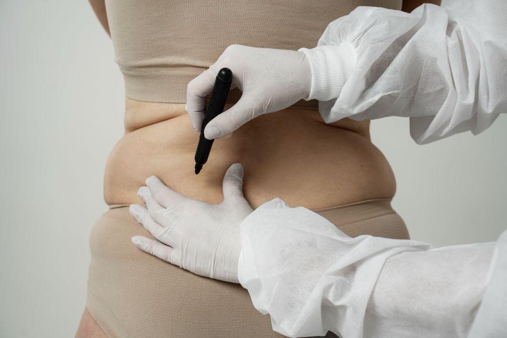 Fakta CryoSlimming, Bisa Kurangi Lemak dan Mengencangkan Kulit?